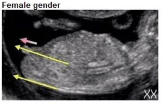Echo met nub horizontaal langs de ruggengraat, kenmerkend voor een meisje