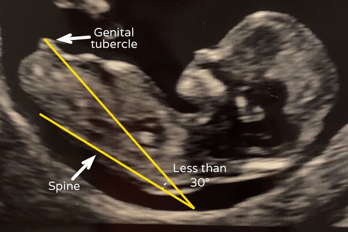 Nub theorie: het geslacht voorspellen bij de 12-weken echo